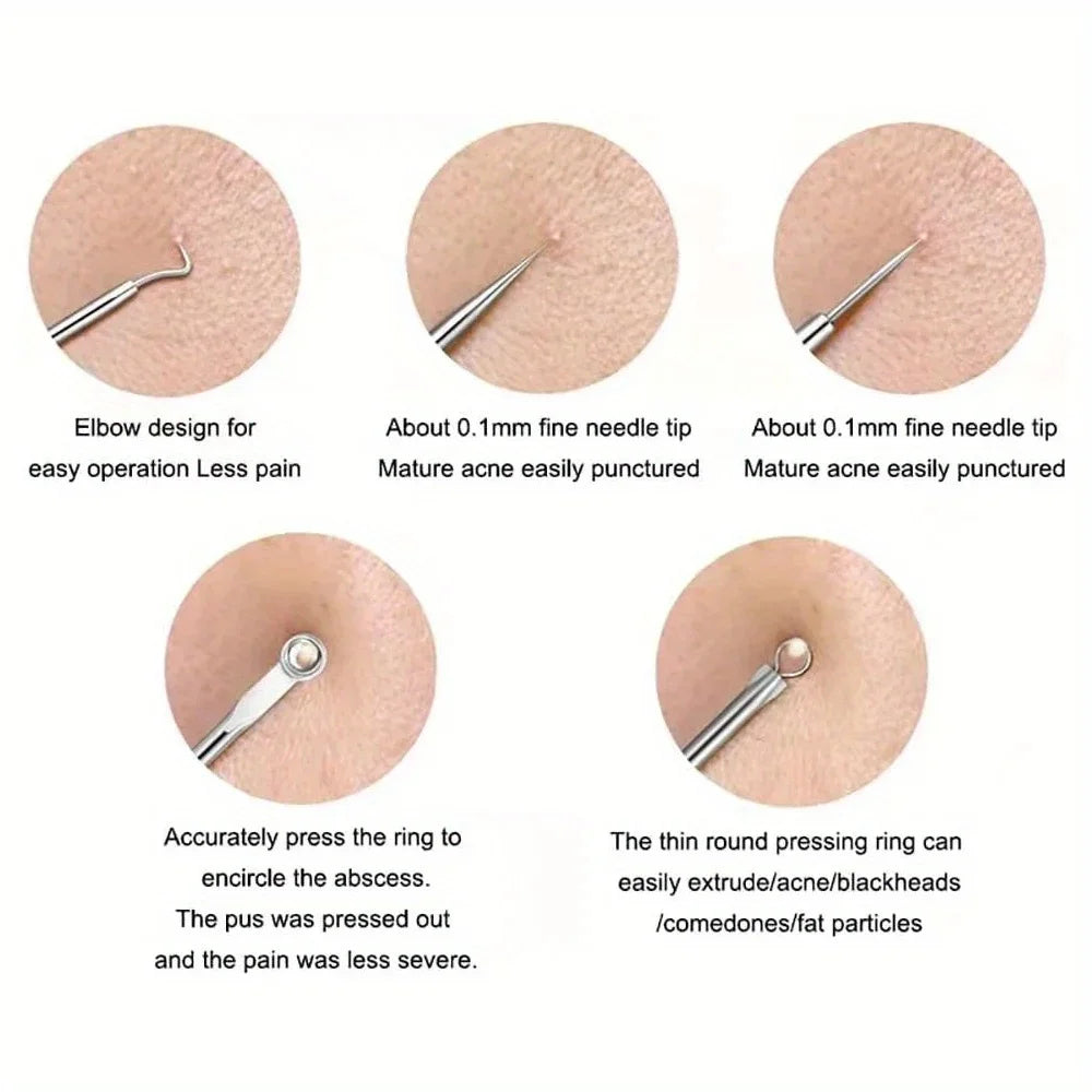 4-in-1 Blackhead & Acne Extractor Kit